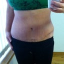 week 4... still a bit lopsided with the swelling. Scar is also higher on one side