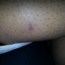 Incision Cuts