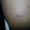 Incision Cuts