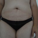Pre-op