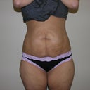 Front / Six weeks post