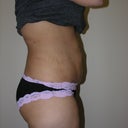 Right Side / Six weeks post