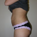 Left Side / Six weeks post