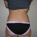 Back / Six weeks post