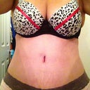 9 days PO and still swollen but very happy with results so far