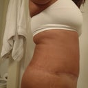10 weeks post op