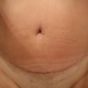 10 weeks post op