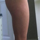 This is my abdomen before the Liposuction and mini tummy tuck.