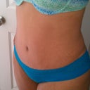 3 month post op