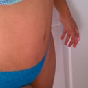 3 month post op