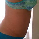 3 month post op