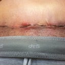 Day 12 PO: Close up of belly incision where it is irritated from binder. Doesn't hurt - just a bit annoying and it itches ferociously.