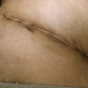 Day 12 PO: Close up of my right side of the belly incision. Sounds like the puckering will smooth out over time.