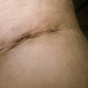Day 12 PO: Left side belly incision.