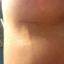Mondors cord it hurts