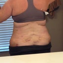 Po day 6 swollen and ugly. Hoping this improves!
