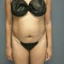 BEFORE FRONT - DAY OF SURGERY