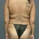 BEFORE BACK- DAY OF SURGERY