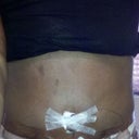 5 days post-op! Looking pretty good so far.