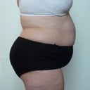 Before Zerona Picture August 6, 2012