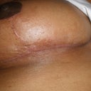 Small opening after scratching - left