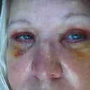 Day 4 stitches out