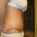 9 days PO side- some bunching.  Dr T said that once my inside stitches dissolve that the skin will lay more flat