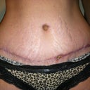 16 weeks scar