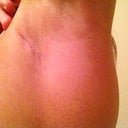 Scar Underarm - 3 Weeks