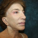 Dr. Aronowitz Before Photo. I paid $18,750 for procedures primarily involving the addition of stem cell fat to restore volume to specific facial areas.