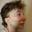 Dr. Aronowitz After Photo. $18,750 and 2 weeks later, Dr. Aronowitz’s own  photo clearly shows there was no noticeable improvement to temples, cheeks, naso-labial folds, lower face, or neck.