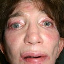 Ocular Surgeon’s Photo Taken 3 Years Before. What one plastic surgeon dubbed, “The Bosch pear look.” My #1 priority was for Dr. Aronowitz to add stem cell fat to my temples.