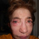 Immediately post-surgery, there was no evidence of stem cell addition to my temples. Dents and depressions remain.