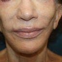 Dr. Aronowitz Before Photo. I paid to have stem cell fat added to my flat right cheek.