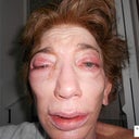 Although my right eye area is still very swollen from eye procedures performed by an ocular surgeon at this same surgery, it is evident that Dr. Aronowitz did not add enough stem cell fat to my right cheek.