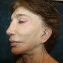 Dr. Aronowitz Before Photo. The “easiest” procedure was supposed to correct the inward curl of my left earlobe.