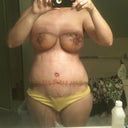 Day 9 PO
I think my incision and my belly button are to close together.