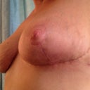 Left profile- the dot yo see on my side is my drain scar.