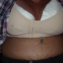 Next day, after wrap was removed