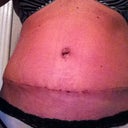Self portrait taken Day 19.  You can see to the side how there is a "ridge."  This is completely normal and nothing to worry about if you have the same thing.  That will subside over time.