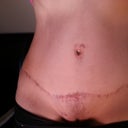 front view 1 yr post op