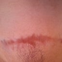 mid section scar