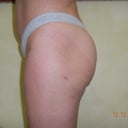 Left side 5 months post op