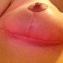 4 weeks post op!!! Right breast. Looking fantastic! I am loving the Bio Oil!
