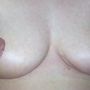4 weeks, both breasts and the incision in my right armpit where my 3rd boob was removed. LOL. I had a ton of breast tissue that needed to be removed.