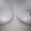 4 weeks, both breasts straight on. Looking much more even in size everyday. The right will remain more swollen due to the extra armpit surgery, but it will eventually settle down. Overall I am very pleased with the turn out. Looking back at the first pictures just makes my back hurt!!!