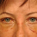 day 7 -after stitch removal.