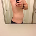Directly After Treatment (Day 1) Side View