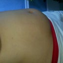 2 Weeks After the Procedure