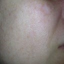 Right side of face - 8 days after IPL.